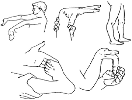 Drawings of hypermobile joints showing the Beighton Scale.