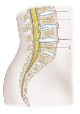 Drawing of cross-section of the spine showing herniated discs. 