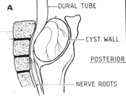 Drawn diagram of a Tarlov Cyst in the spine. 